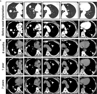 Case Report: Successful Control of Pulmonary Metastatic Pheochromocytoma With Iodine-125 Seed Implantation